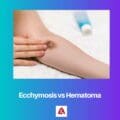 Ecchymosis Vs Hematoma Difference And Comparison