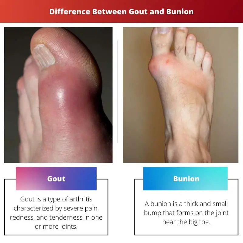 Difference Between Gout and Bunion