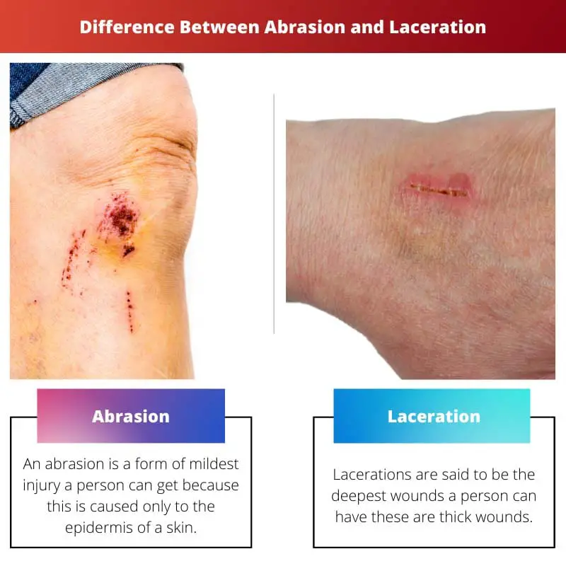 Difference Between Abrasion and Laceration