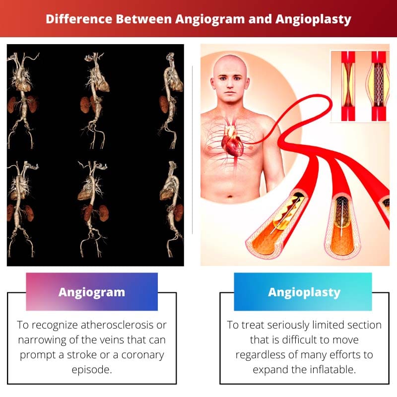 Difference Between Angiogram and Angioplasty