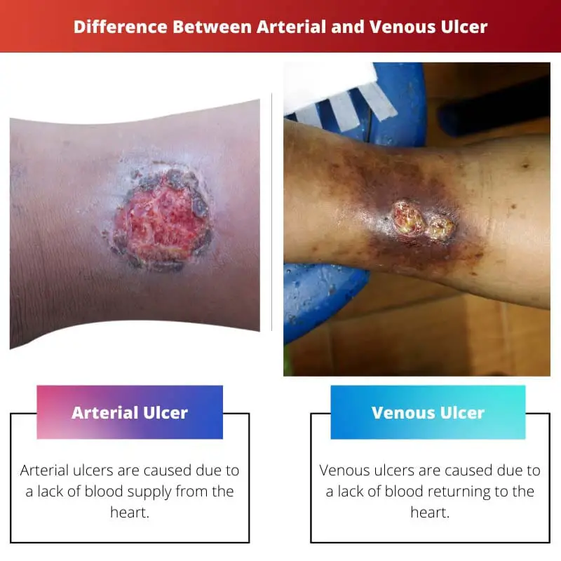 Difference Between Arterial and Venous Ulcer