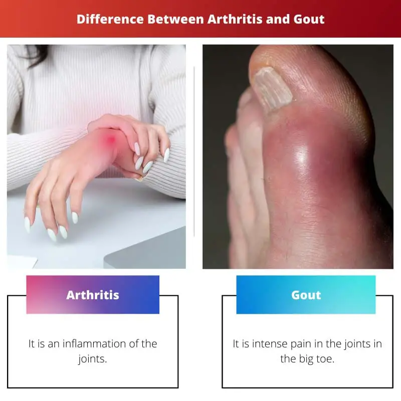 Difference Between Arthritis and Gout