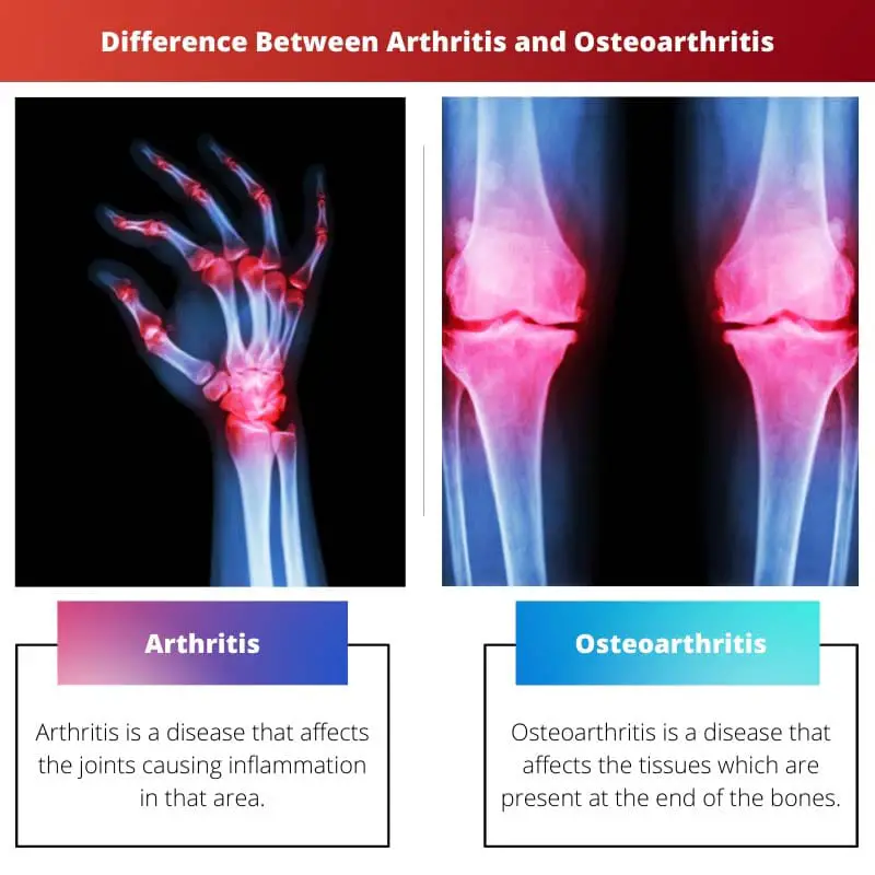 Difference Between Arthritis and Osteoarthritis