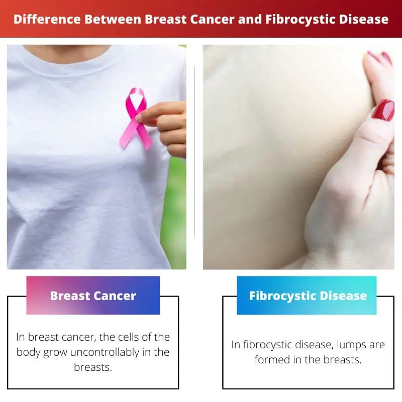 Difference Between Breast Cancer and Fibrocystic Disease