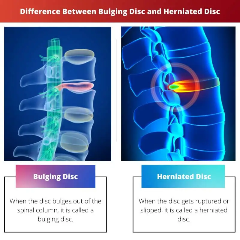 Difference Between Bulging Disc and Herniated Disc