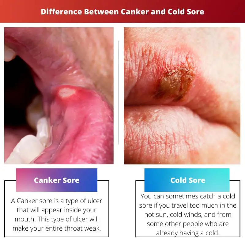 Difference Between Canker and Cold Sore