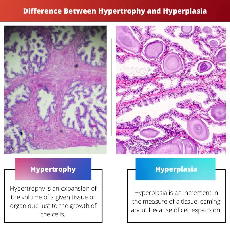Difference Between Hypertrophy and Hyperplasia