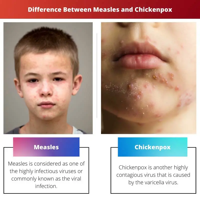 Difference Between Measles and