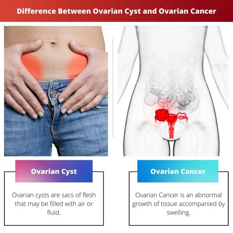 Difference Between Ovarian Cyst and Ovarian Cancer
