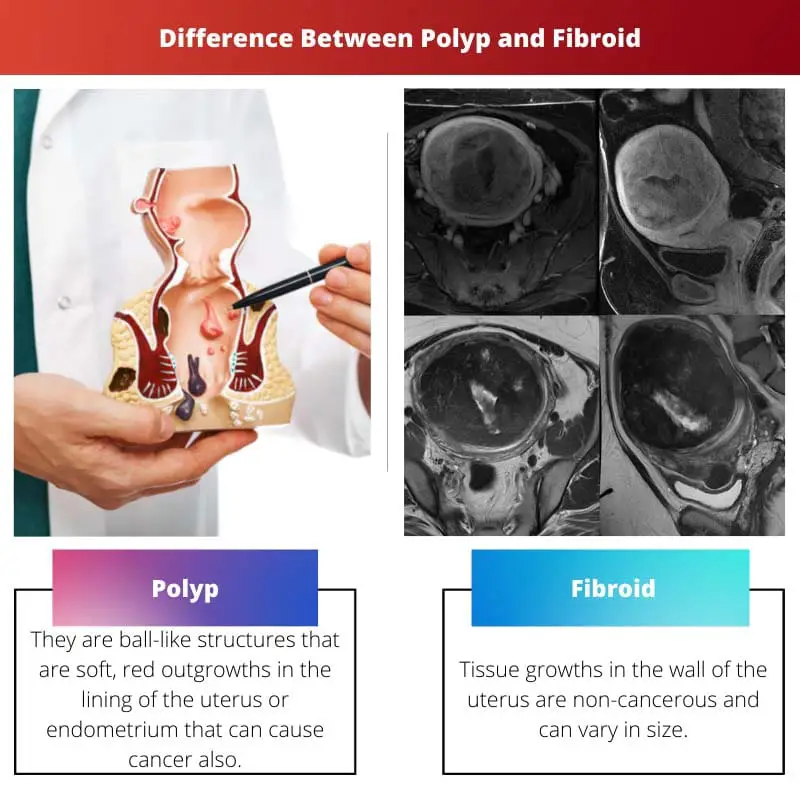 Difference Between Polyp and Fibroid