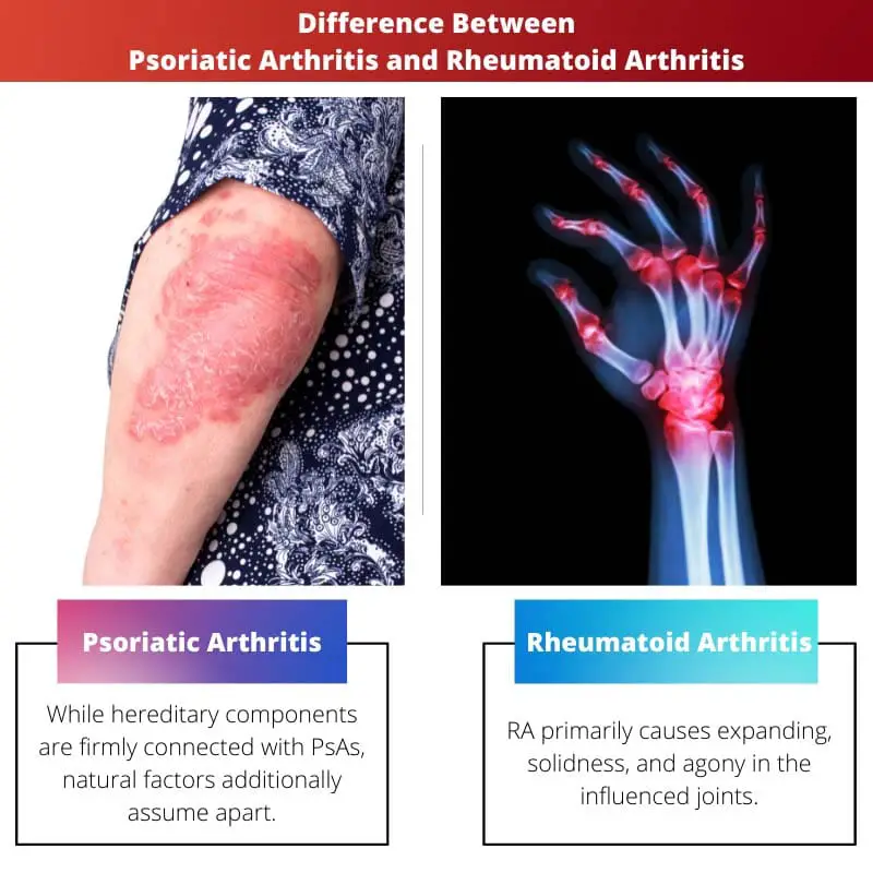 Difference Between Psoriatic Arthritis and Rheumatoid Arthritis