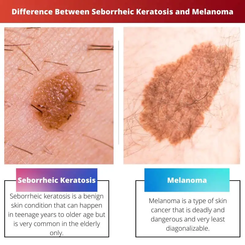Difference Between Seborrheic Keratosis and Melanoma