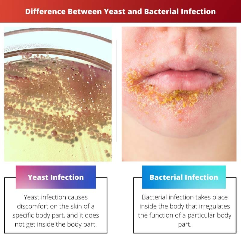 Difference Between Yeast and Bacterial Infection