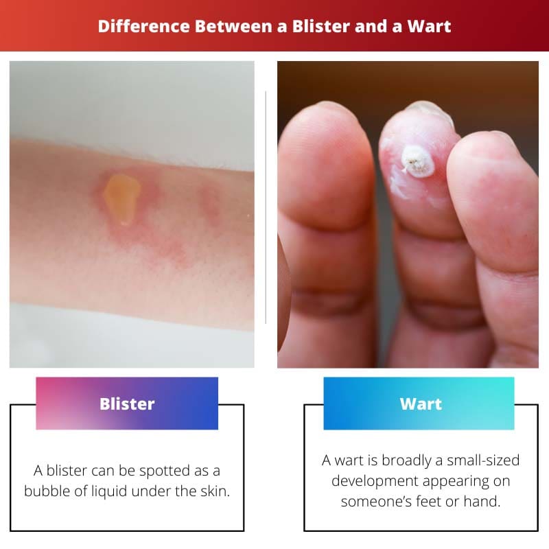 Difference Between a Blister and a Wart