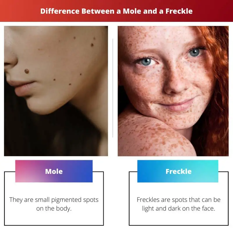 Difference Between a Mole and a Freckle