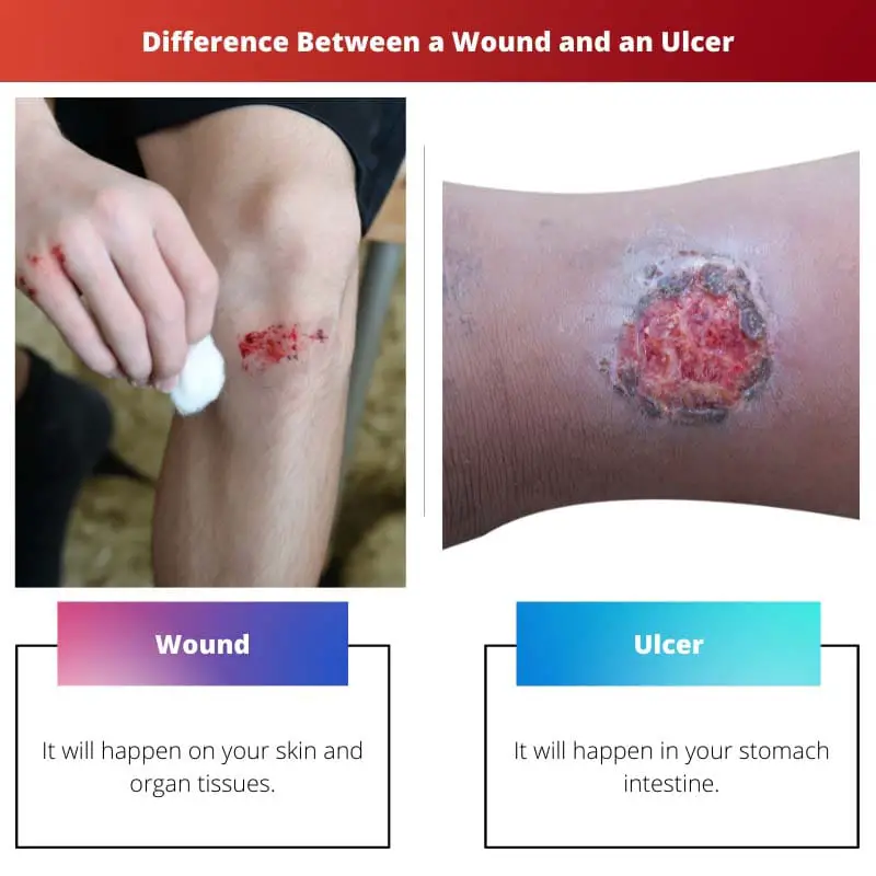 Difference Between a Wound and an Ulcer