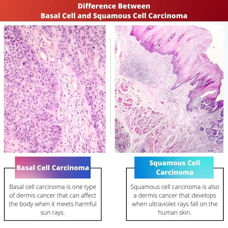 Difference Between Basal Cell and Squamous Cell Carcinoma