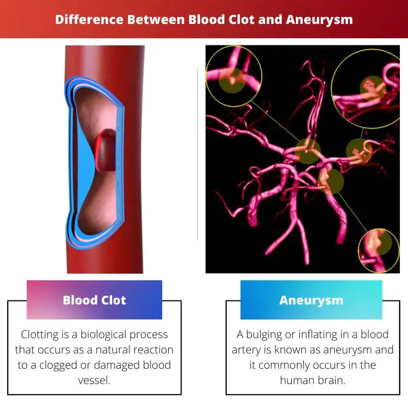 Difference Between Blood Clot and Aneurysm