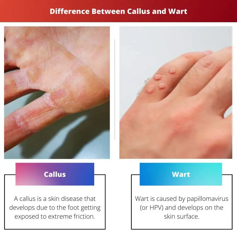 Difference Between Callus and Wart
