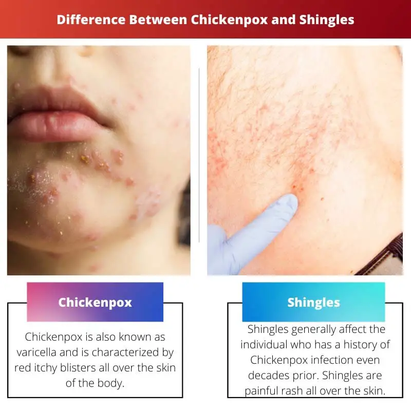 Difference Between Chickenpox and Shingles