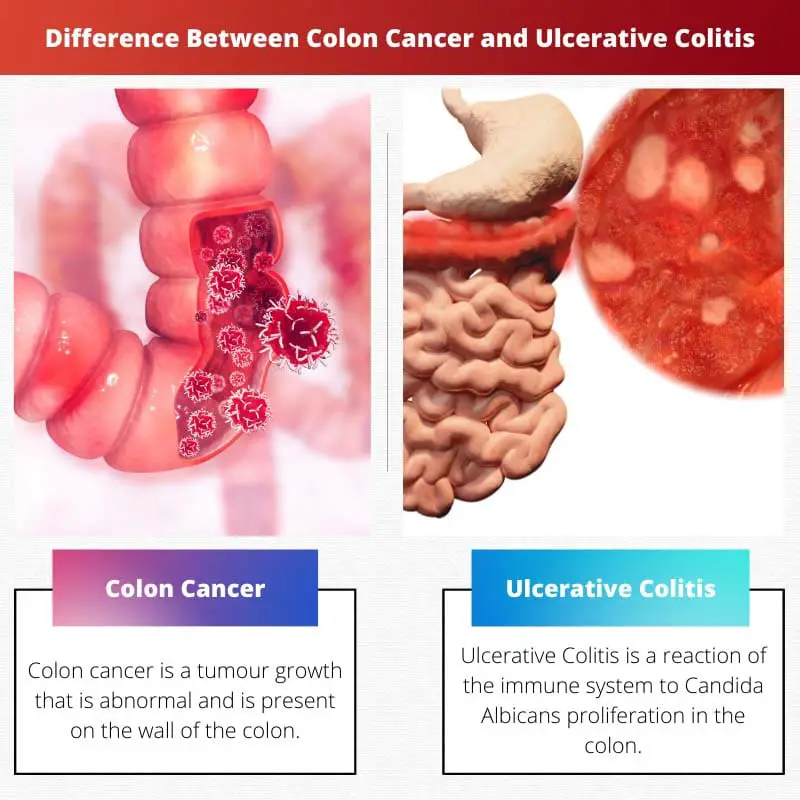 Difference Between Colon Cancer and Ulcerative Colitis