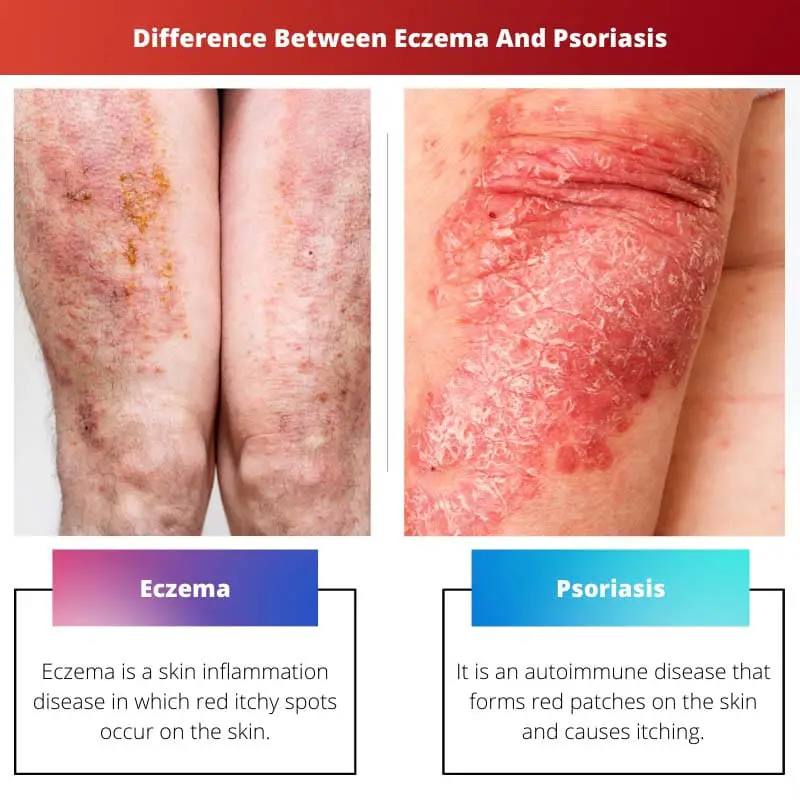 Difference Between Eczema And Psoriasis