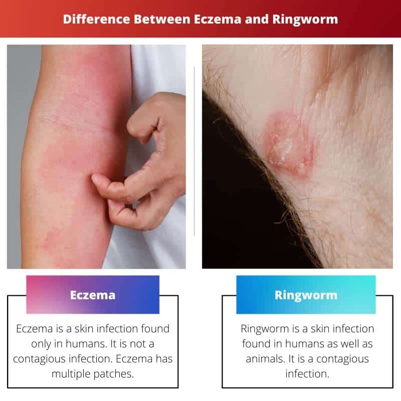 Eccema Vs Tiña Diferencia Y Comparación 7995