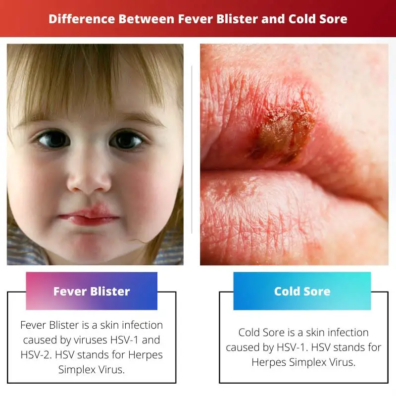 Difference Between Fever Blister and Cold Sore