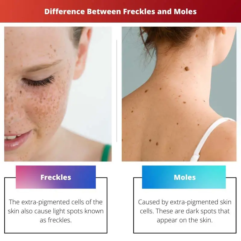 Difference Between Freckles and Moles
