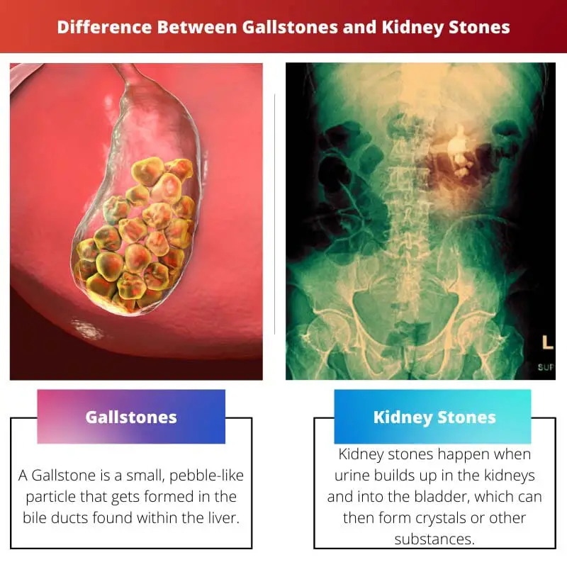 Difference Between Gallstones and Kidney Stones