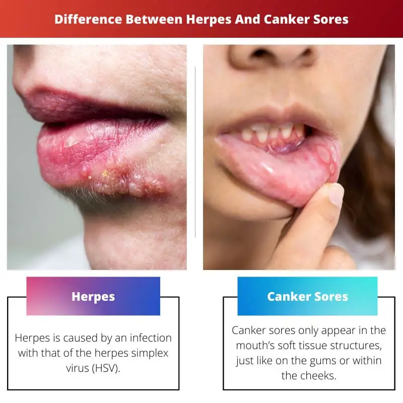 Difference Between Herpes And Canker Sores