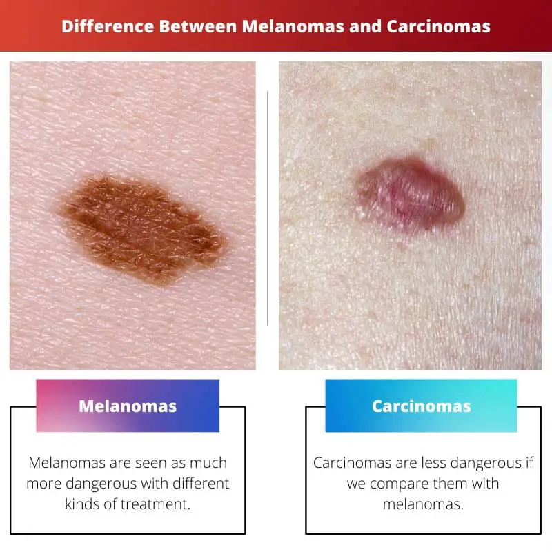 Difference Between Melanomas and Carcinomas