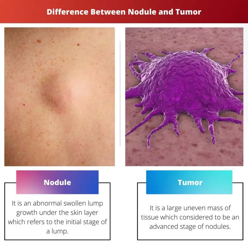 Difference Between Nodule and Tumor