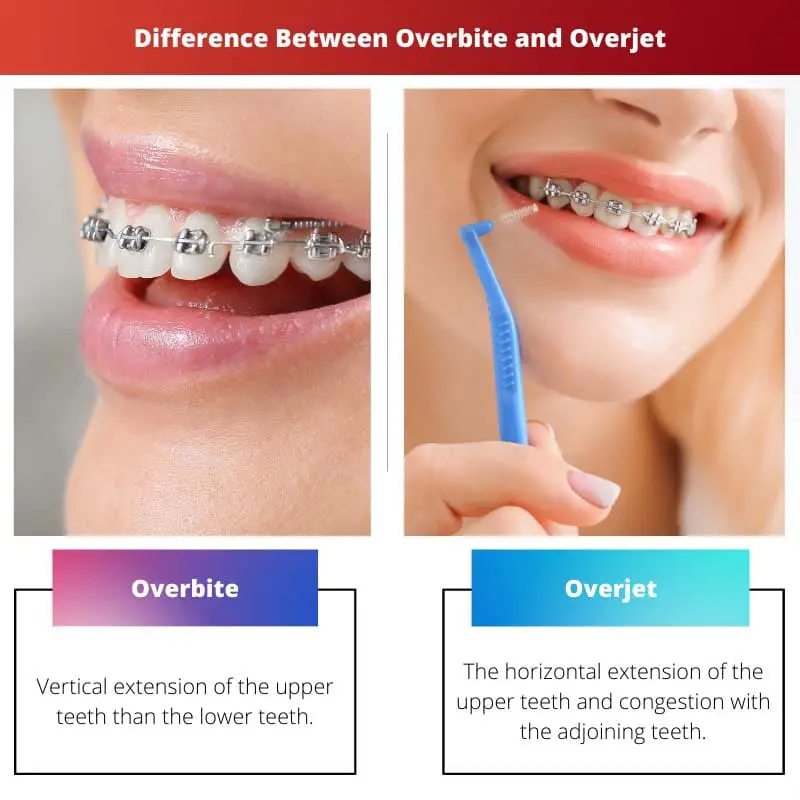 Difference Between Overbite and Overjet