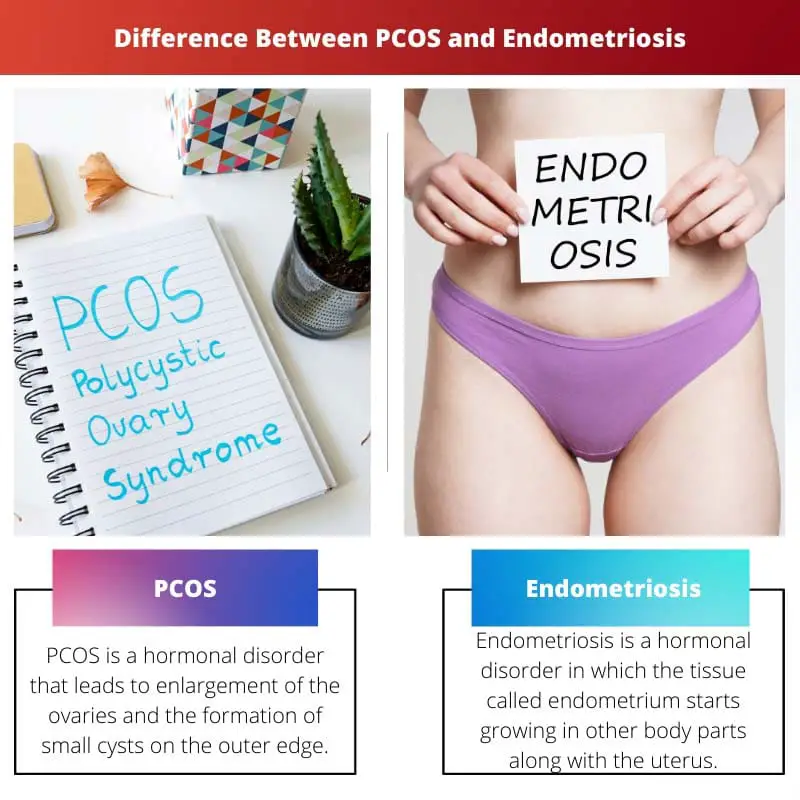 Difference Between PCOS and Endometriosis