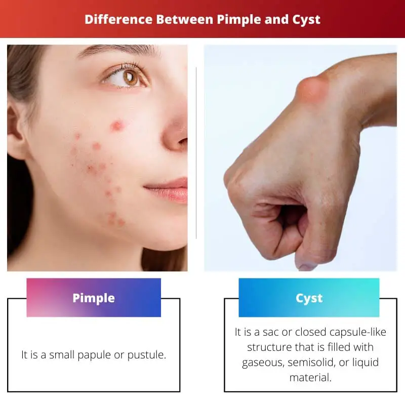 Difference Between Pimple and Cyst