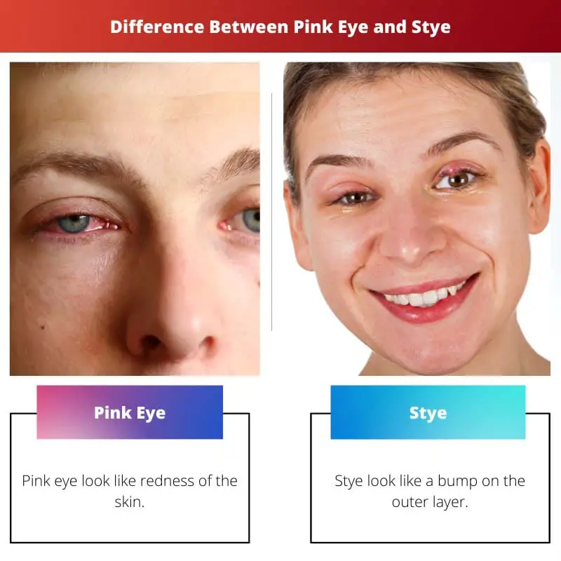 Difference Between Pink Eye and Stye