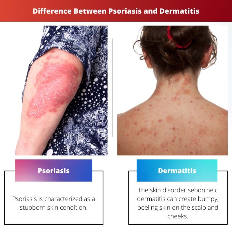 Difference Between Psoriasis and Dermatitis