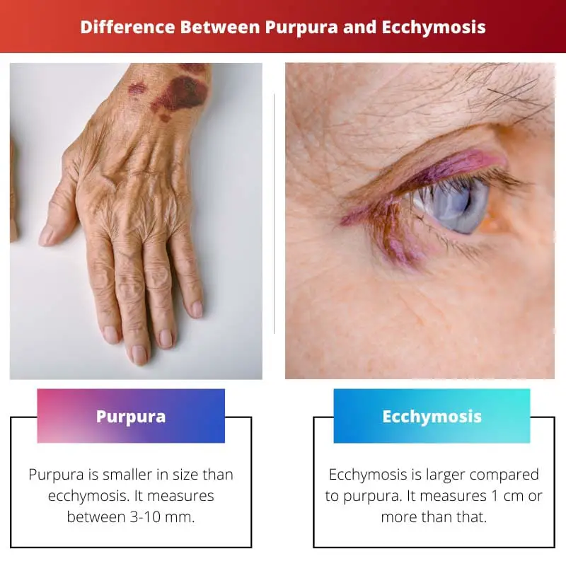 Difference Between Purpura and Ecchymosis