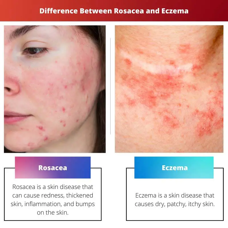 Difference Between Rosacea and Eczema