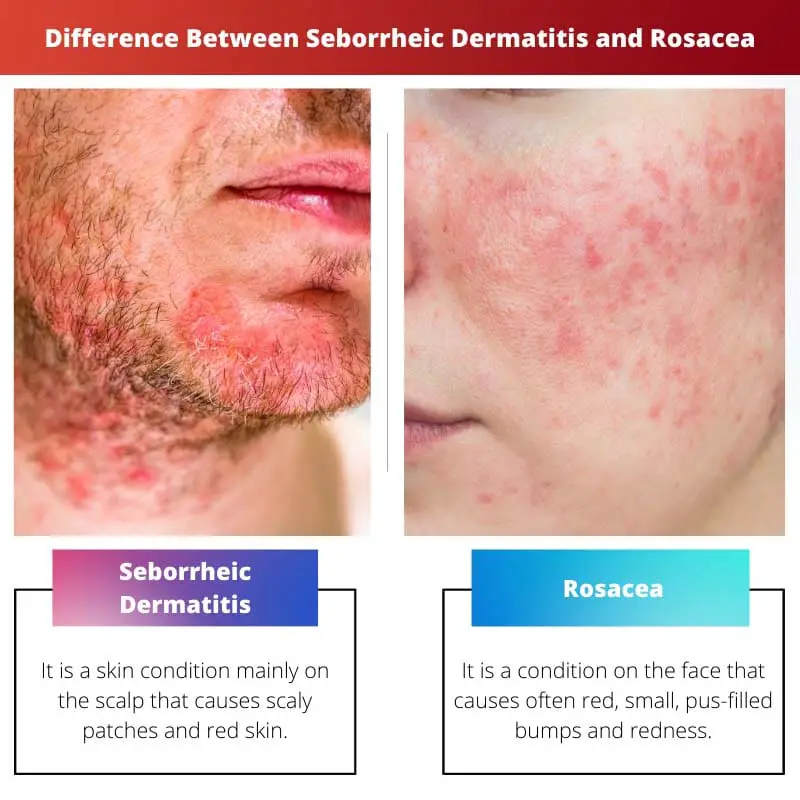 Perbedaan Antara Dermatitis Seboroik Dan Rosacea