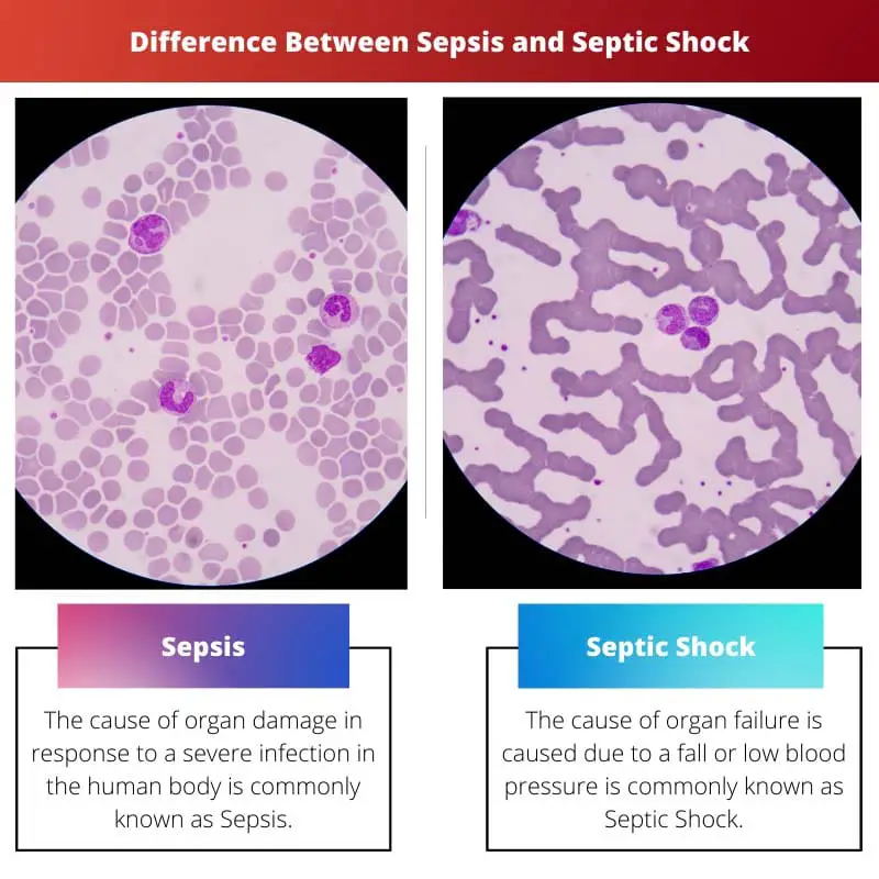 Difference Between Sepsis and Septic Shock