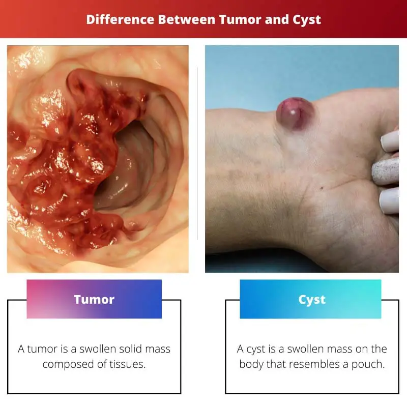 Difference Between Tumor and Cyst