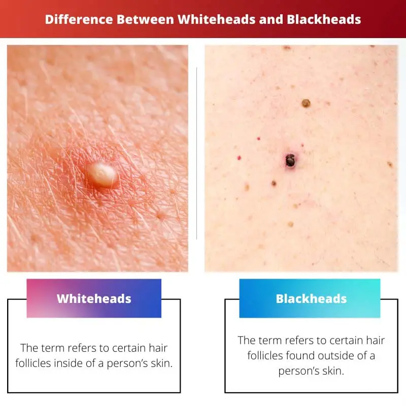 Difference Between Whiteheads and Blackheads