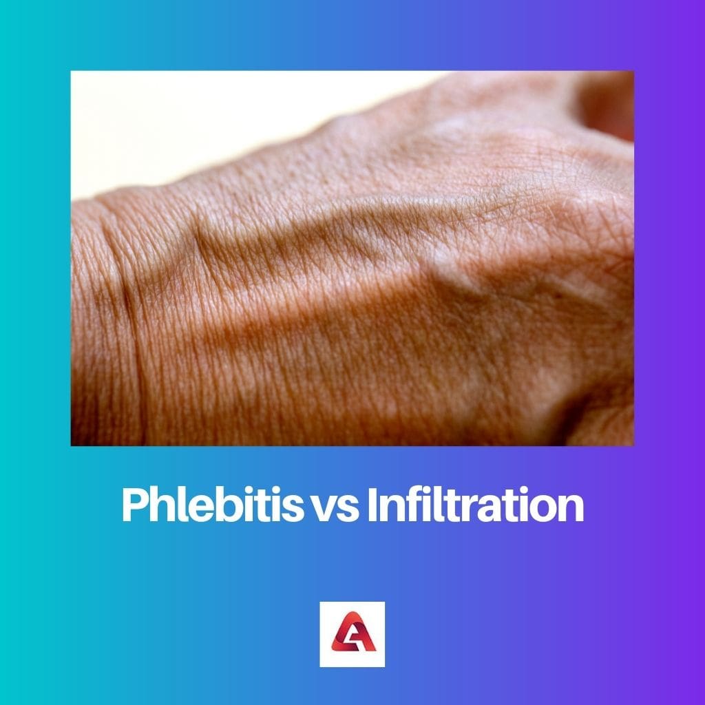 Phlebitis vs Infiltration 1