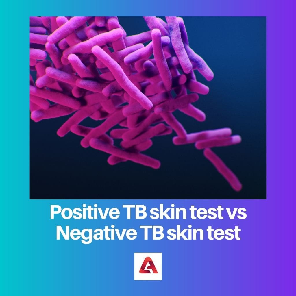 Positive TB skin test vs Negative TB skin test 1