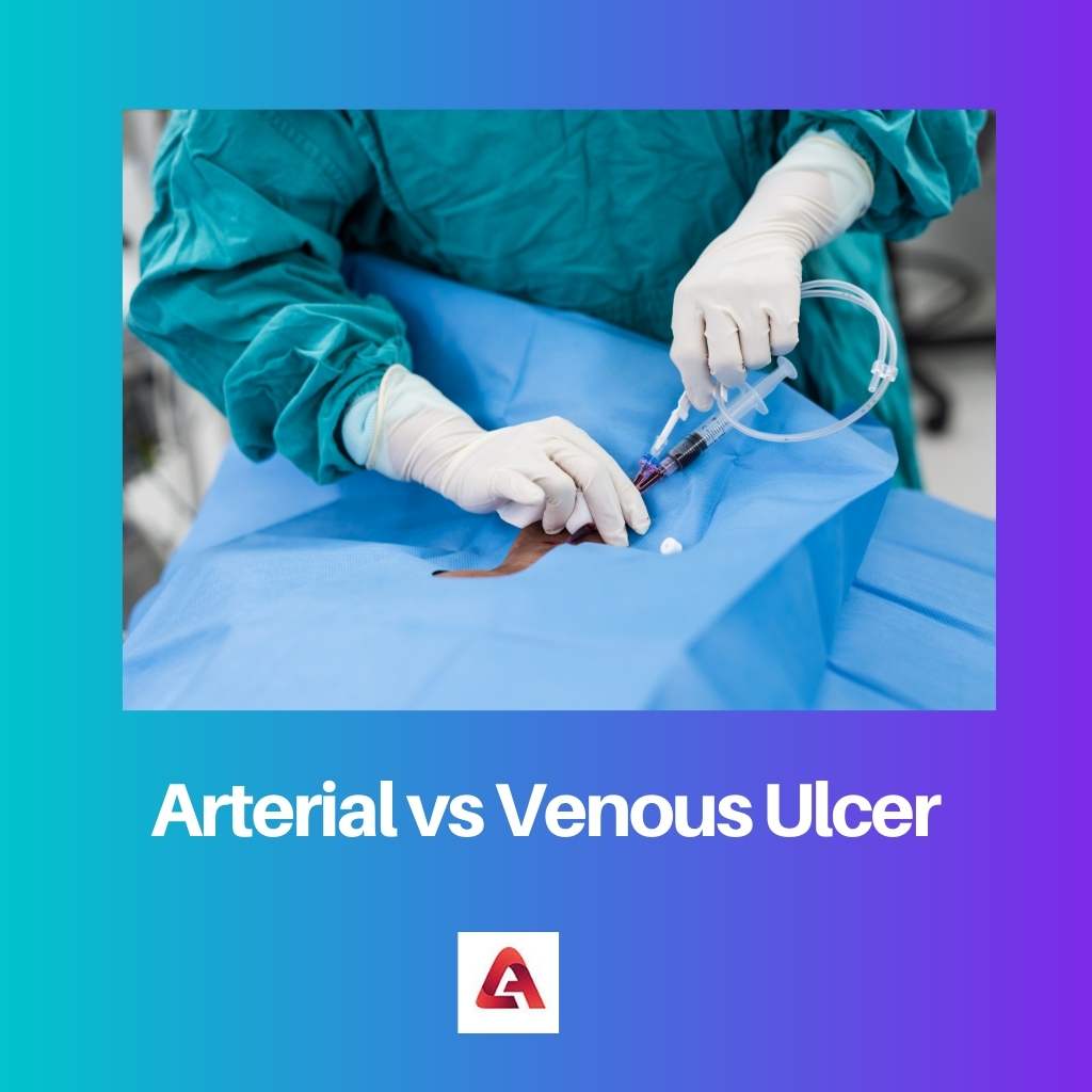 Arterial vs Venous Ulcer