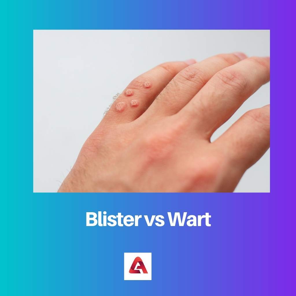 Blister vs Wart