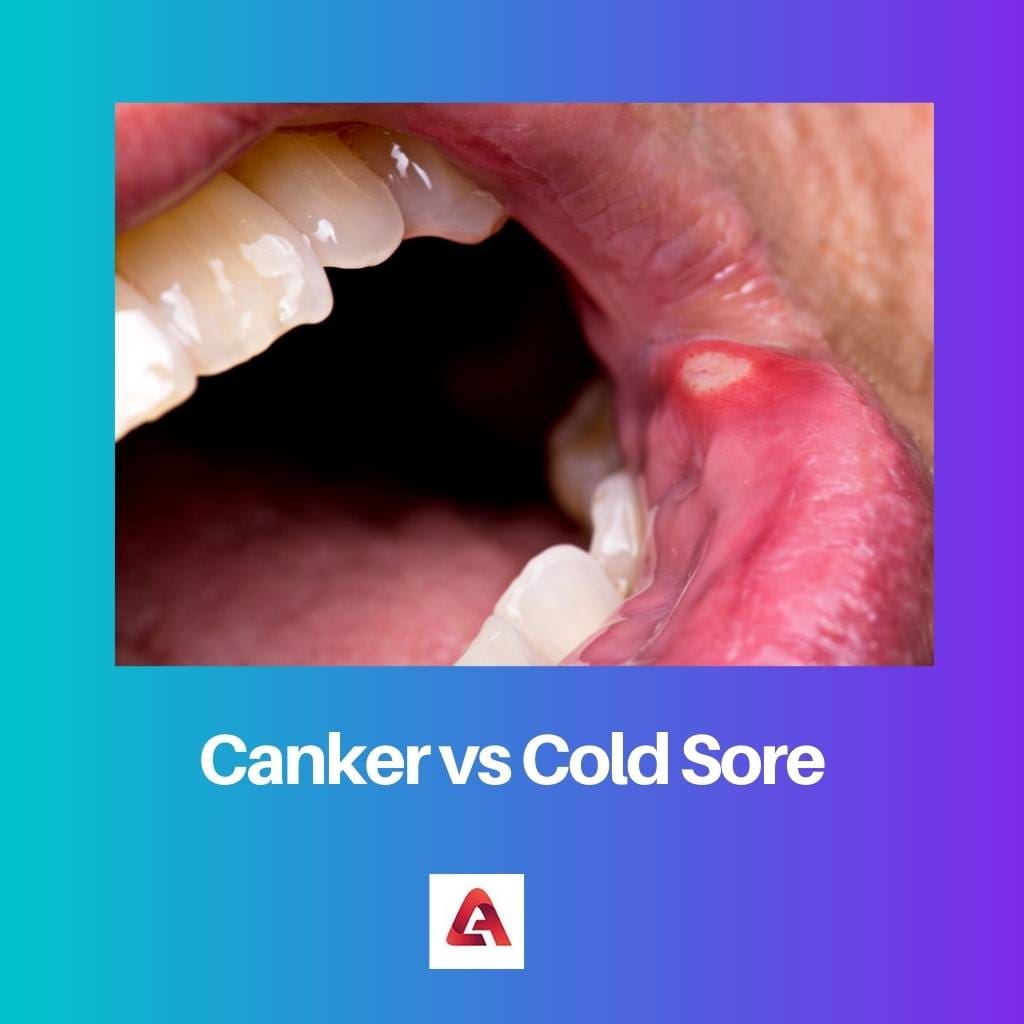 Canker vs Cold Sore