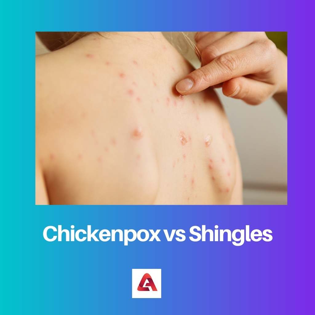 Chickenpox vs Shingles